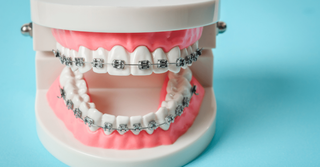 Freedom to Smile Bright: Embrace Braces in Tulsa this Independence Day!