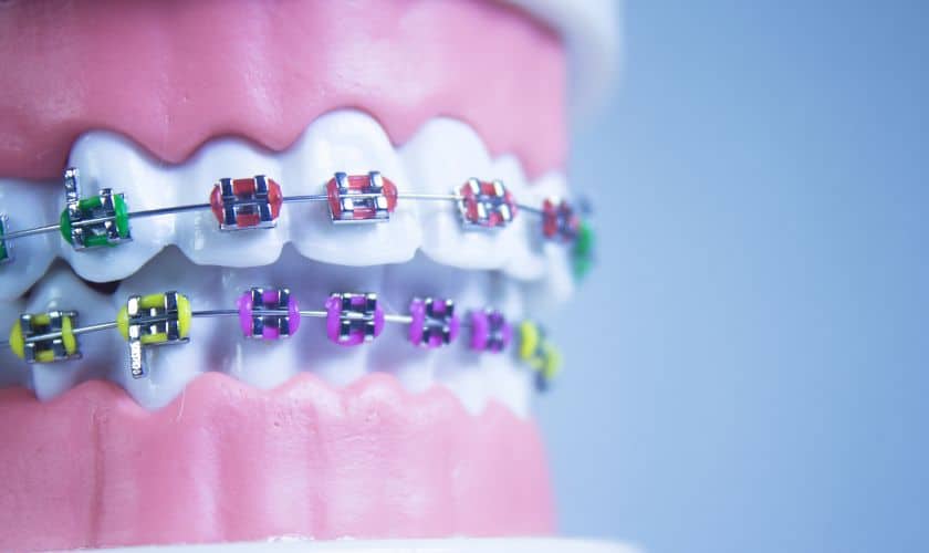 Trendsetting Smiles: The Latest in Orthodontic Fashion